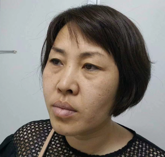 眼袋手术