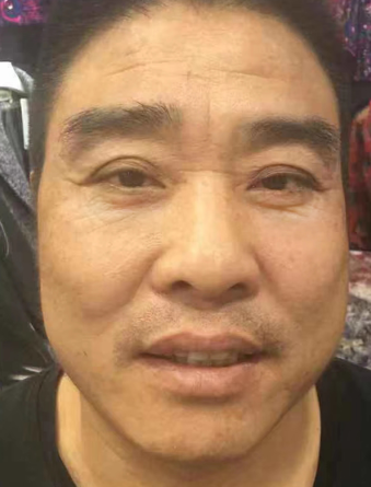 眼袋手术