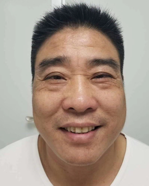 眼袋手术