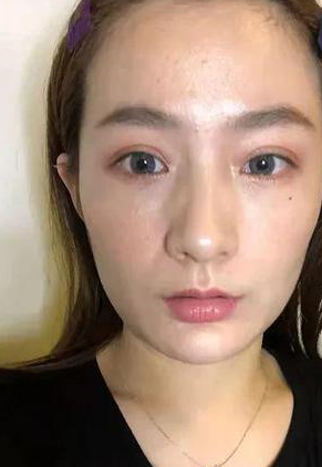 眼袋手术