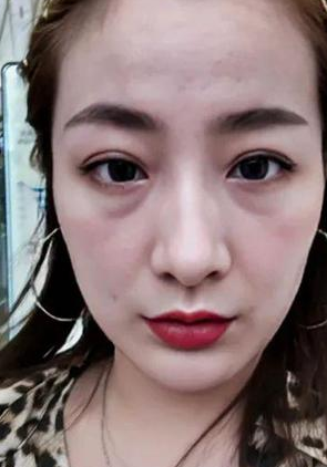 眼袋手术