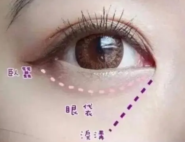 眼袋手术