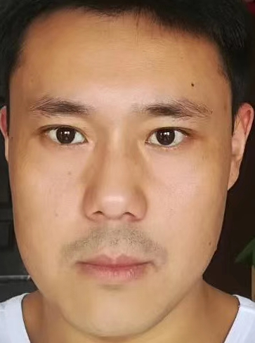 眼袋手术
