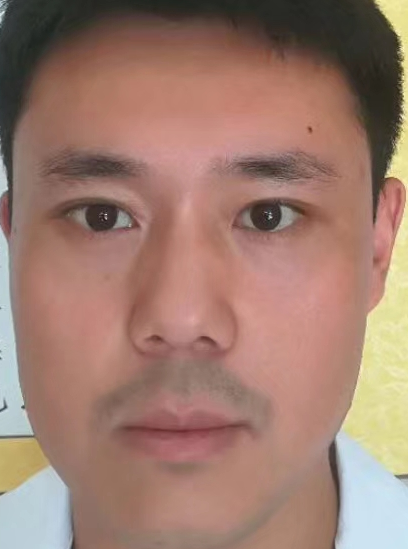 眼袋手术