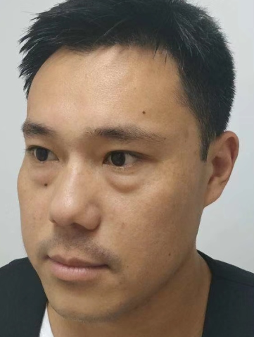 眼袋手术