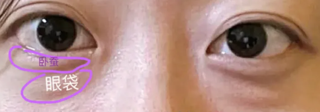 眼袋手术