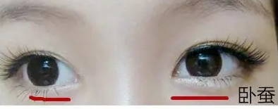 眼袋手术