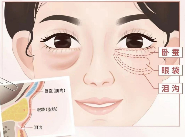 去眼袋手术
