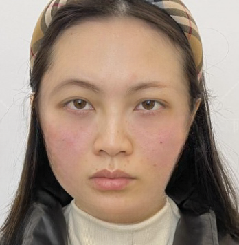 去眼袋手术