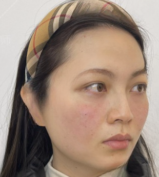 去眼袋手术