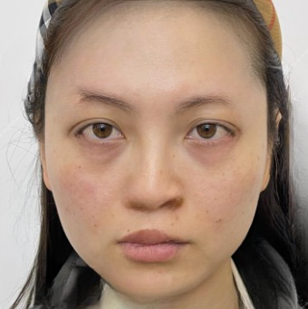 去眼袋手术