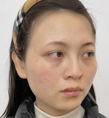 去眼袋手术