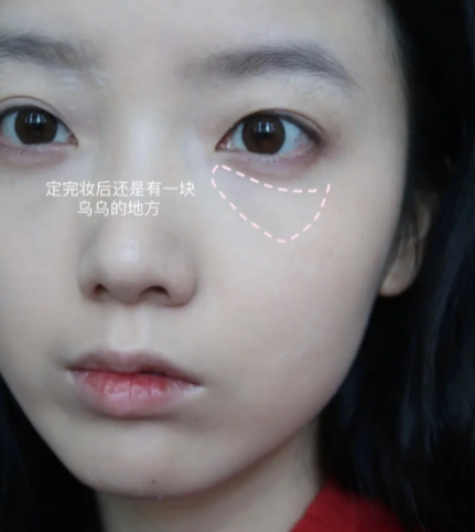 眼袋手术