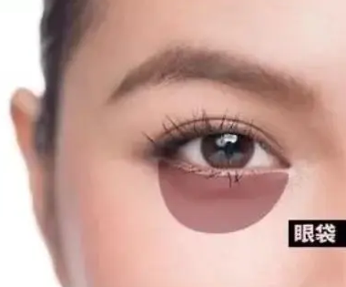 去眼袋手术