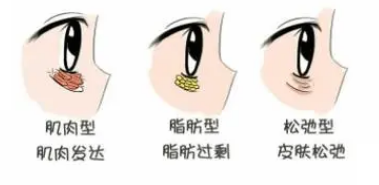 眼袋