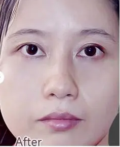 眼袋