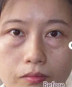 眼袋
