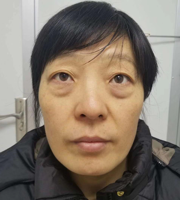 眼袋