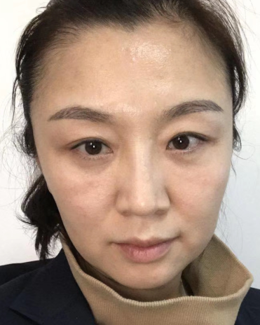 眼袋
