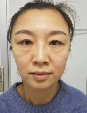 眼袋