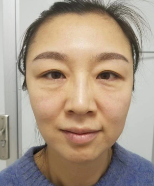眼袋