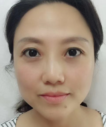 眼袋