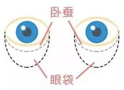 眼袋