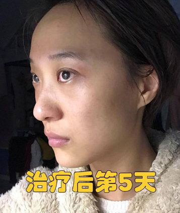 眼袋