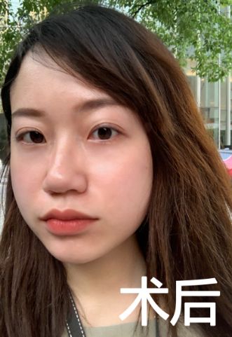 眼袋
