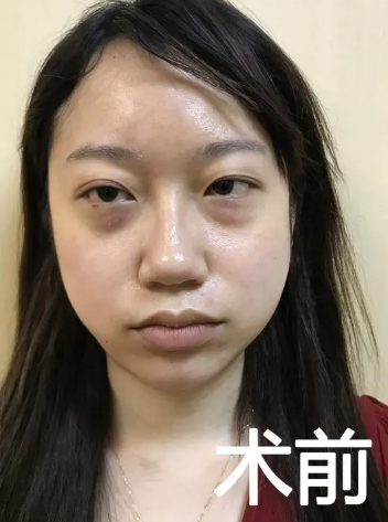 眼袋