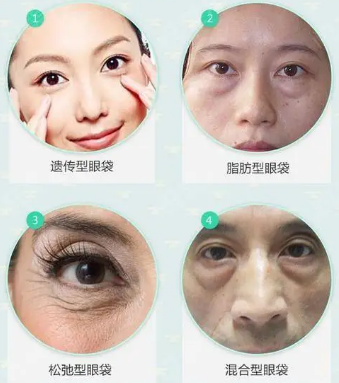 眼袋