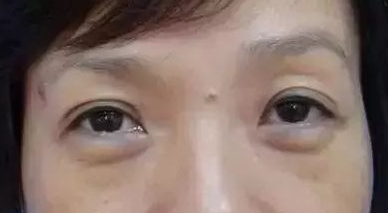 眼袋