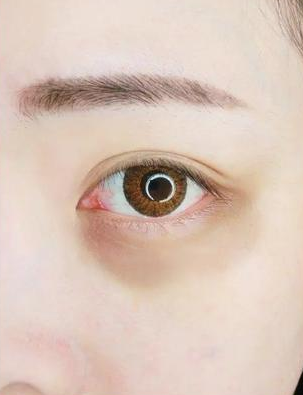 眼袋