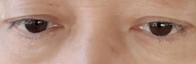 眼袋