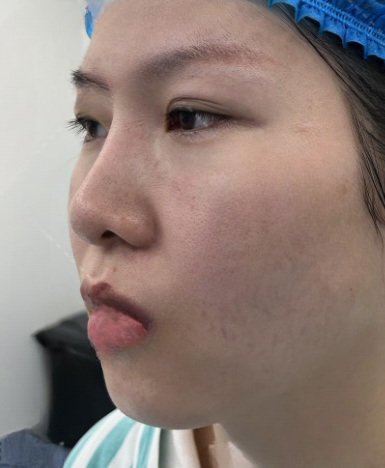 去眼袋手术