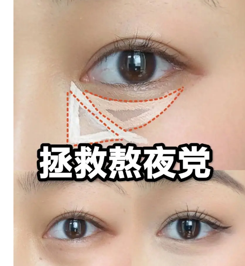 去眼袋手术