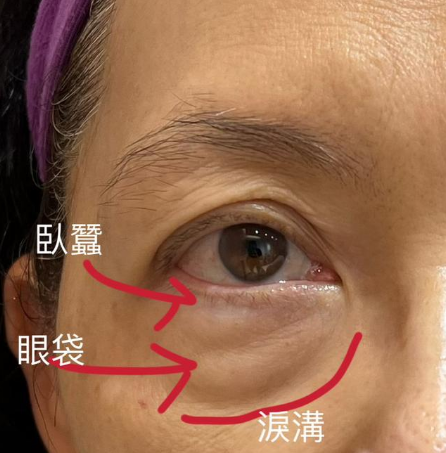 眼袋手术