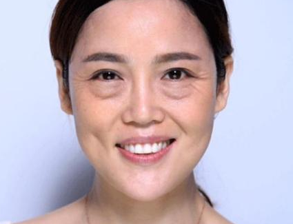 眼袋手术