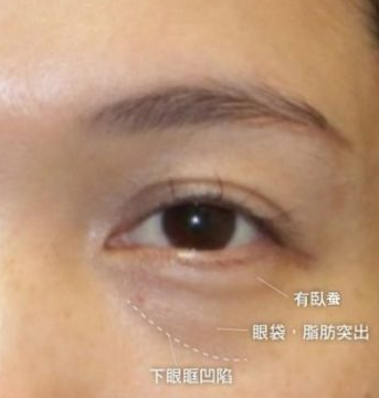 眼袋手术