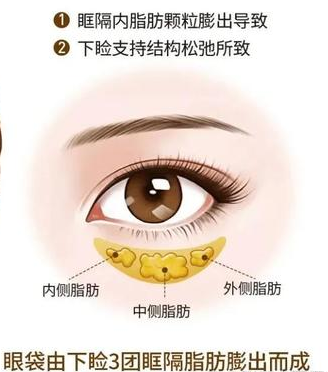 眼袋手术