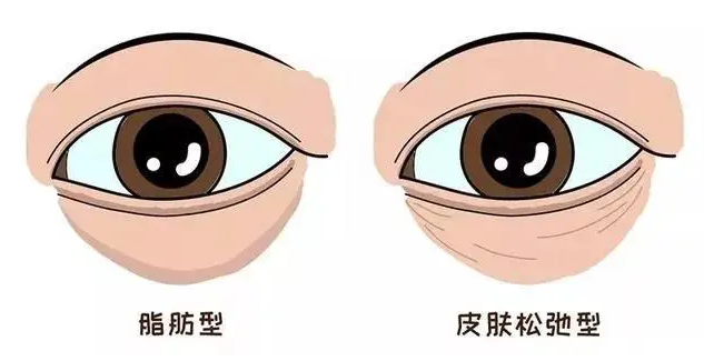 去眼袋手术