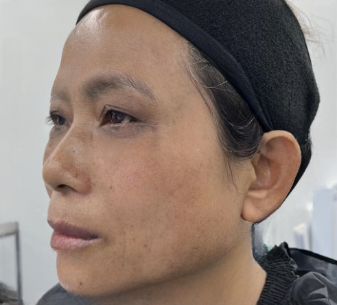 去眼袋手术