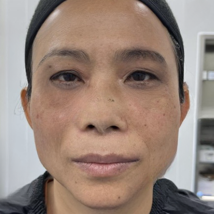 去眼袋手术