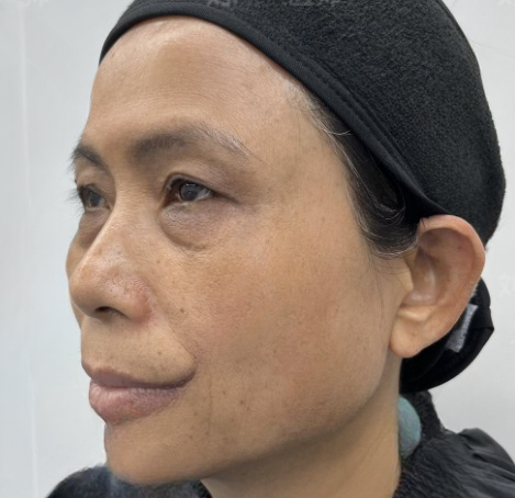 去眼袋手术