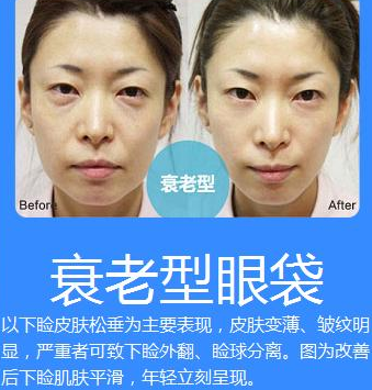 去眼袋手术