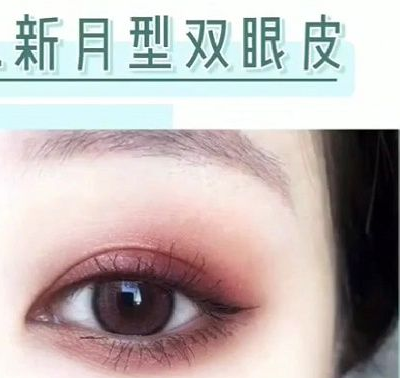 双眼皮手术