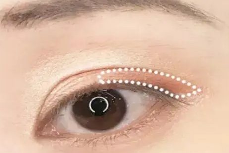 双眼皮手术