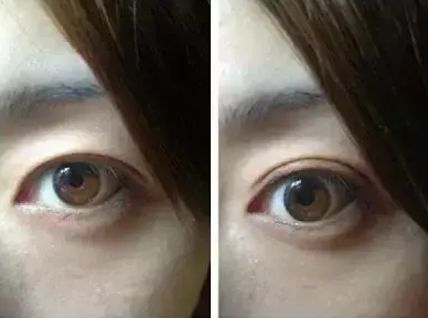 双眼皮手术