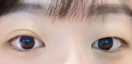 双眼皮手术