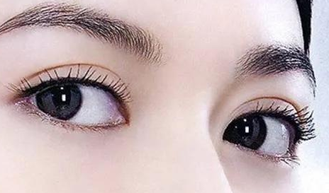 双眼皮